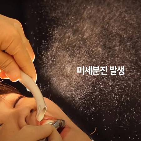 구강외 석션 없이 치아를 삭제할 때 분진이 퍼지는 모습