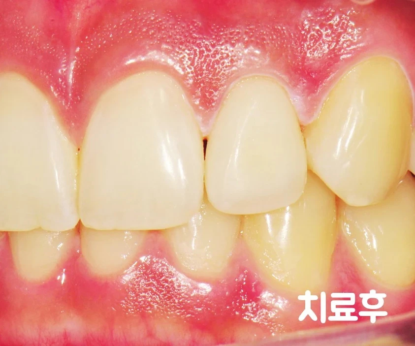 After — restored with an all-ceramic crown.