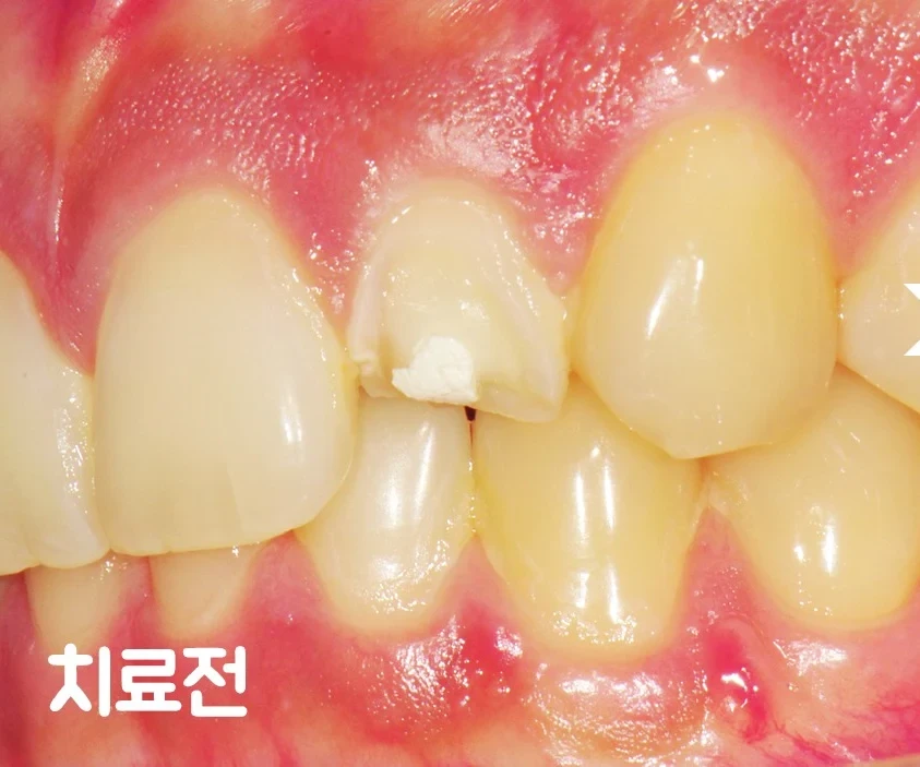 Before — a chipped front tooth.
