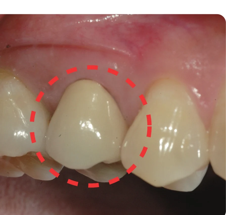 After — finished with a PFM crown.