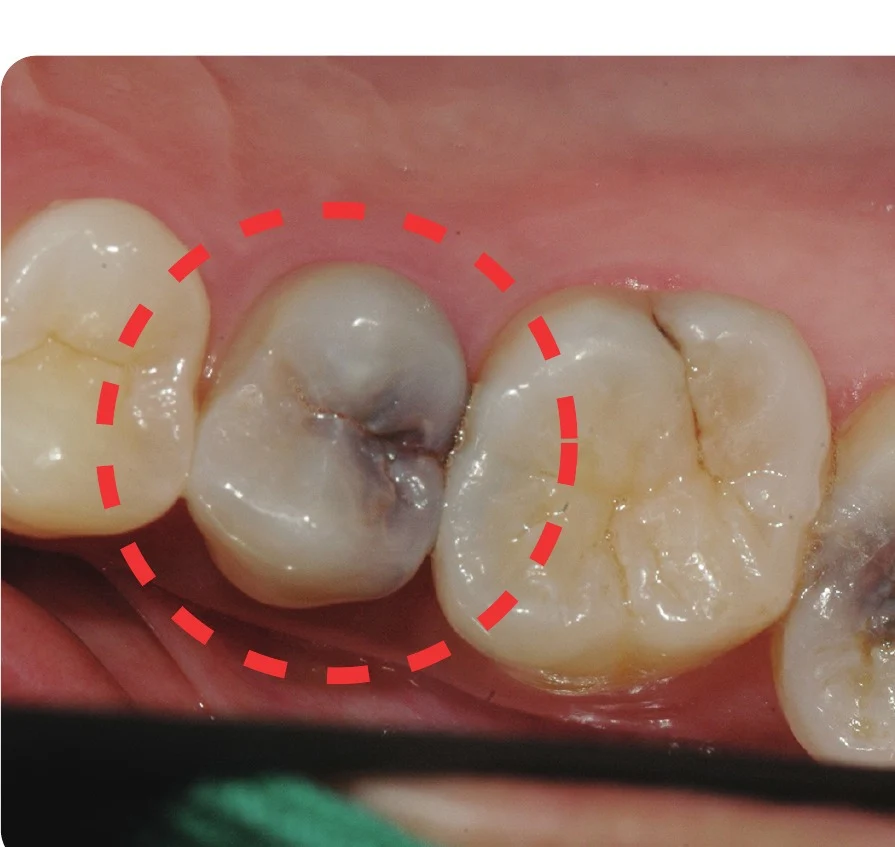 Before — visible decay on a molar.