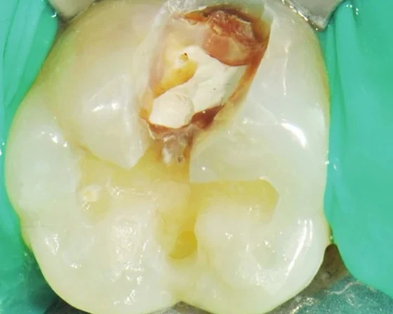 02 The decay is exposed and its extent assessed.