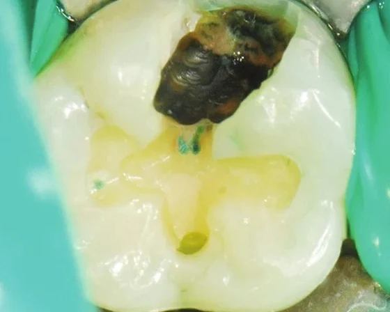 03 Only the decayed tissue is removed; healthy structure is preserved.