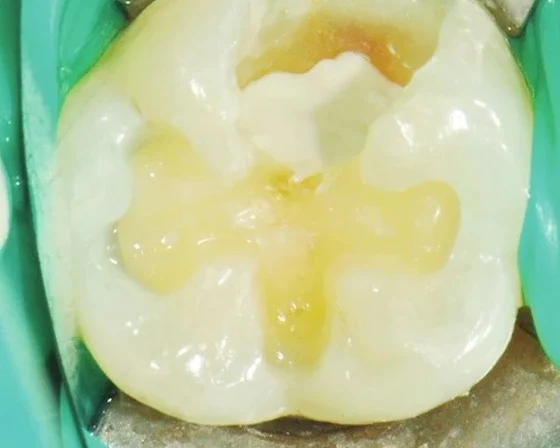 05 A bonding agent is applied to the tooth surface to strengthen the adhesion.