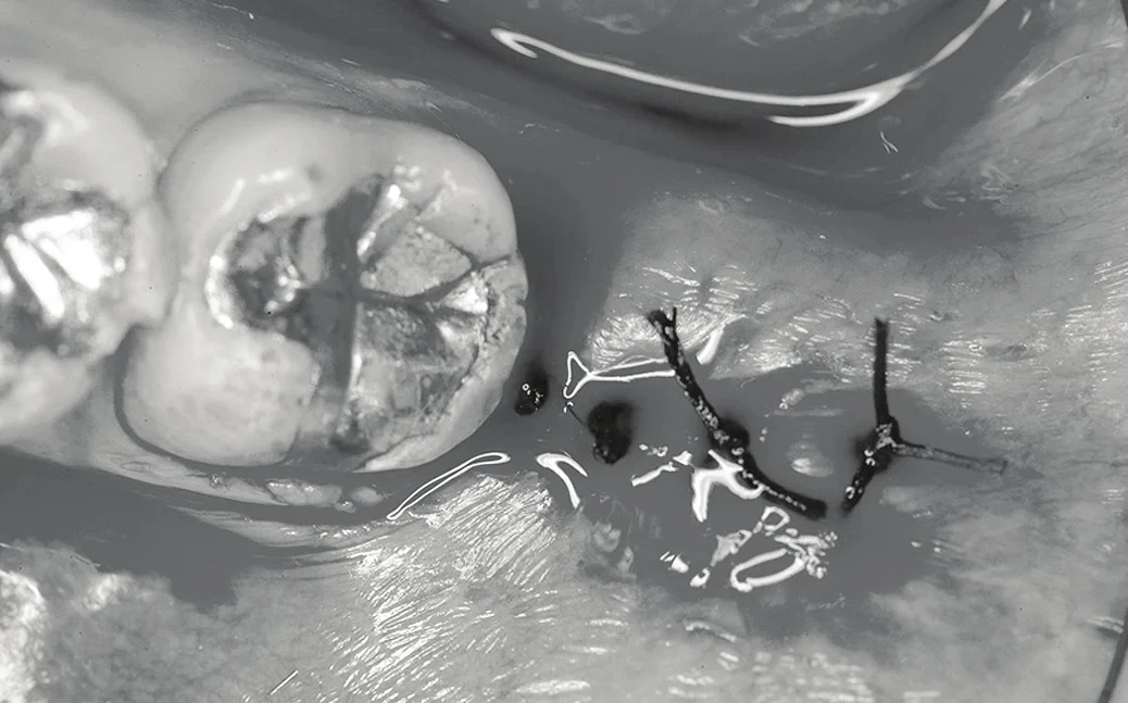 After — the site has been sutured.