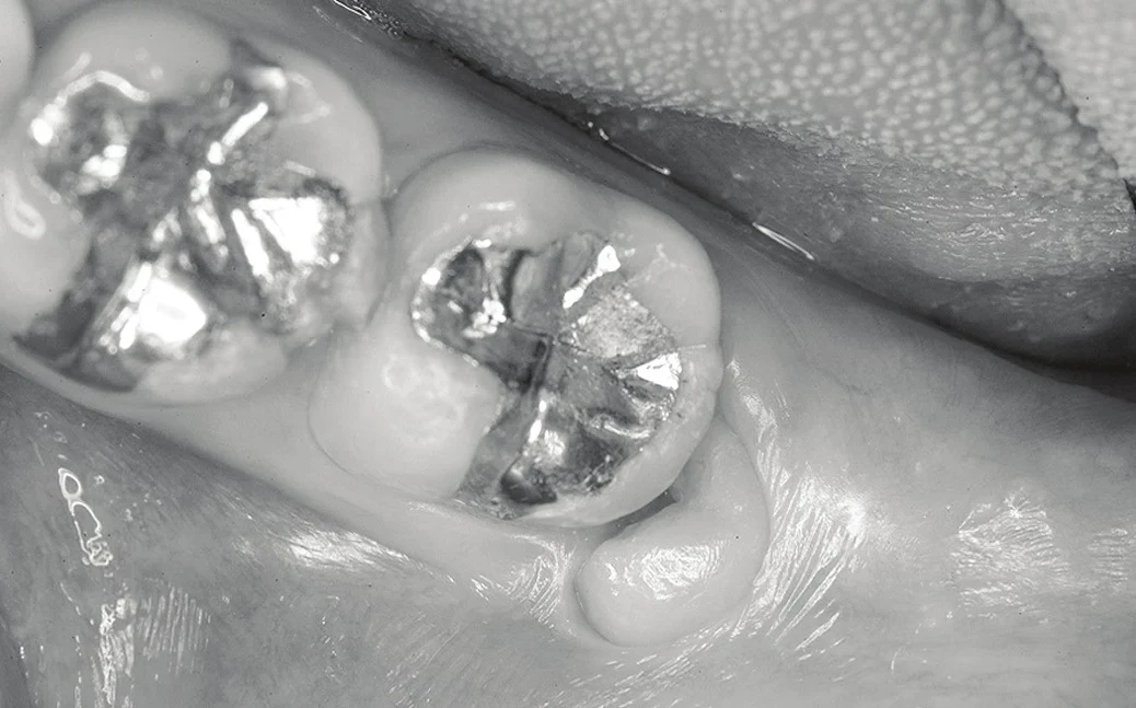 Before — imaging confirms the distance to the nerve.