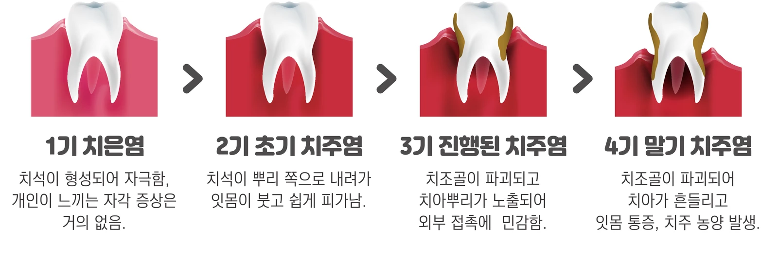 Left untreated, calculus causes bleeding gums and loose teeth, and in severe cases can lead to tooth loss.