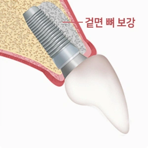 필요 시 겉면 뼈를 보강해 노출을 방지