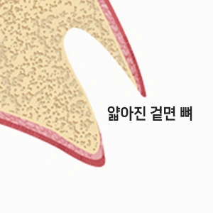 앞니는 어금니보다 겉면 뼈(겉면 골)가 얇습니다