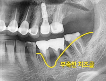 치조골 재생술(뼈이식) — 치료 전