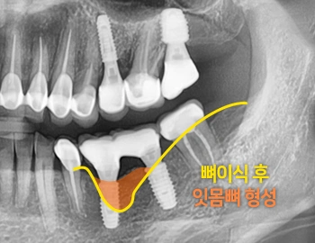 치조골 재생술(뼈이식) — 치료 후