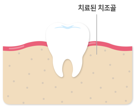 뼈이식 양이 많은 경우