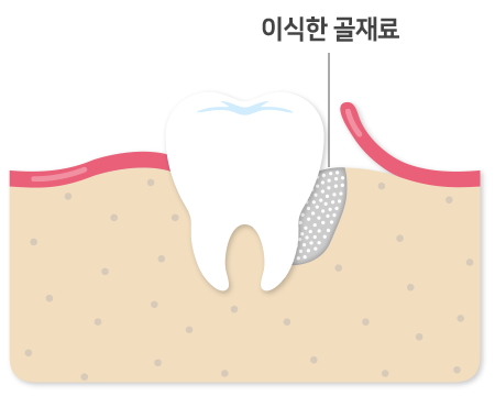 뼈이식 양이 적은 경우