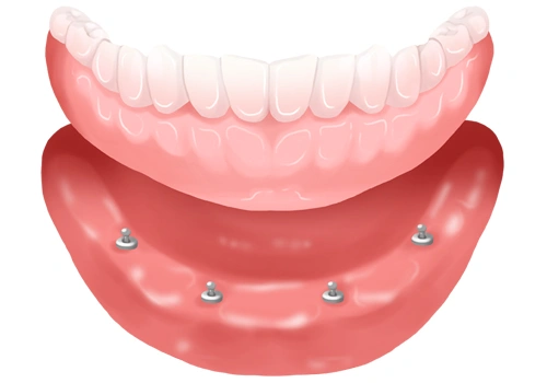 Implant-supported denture