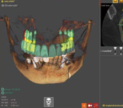The surgical guide is designed by your own dentist