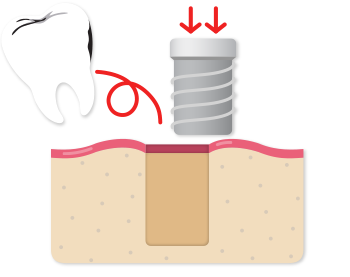 Implant placed at the same time as extraction