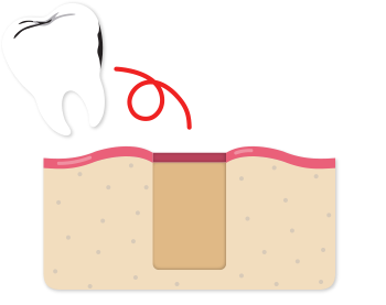 Tooth extraction
