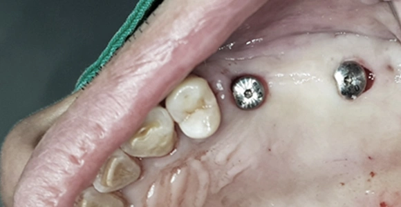 Flapless surgery for faster recovery