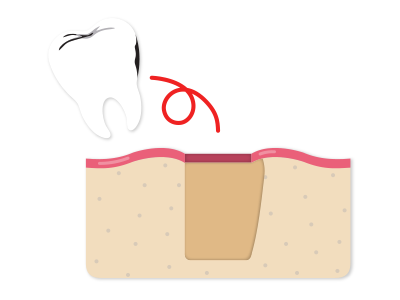 After a detailed examination, the affected tooth is extracted.