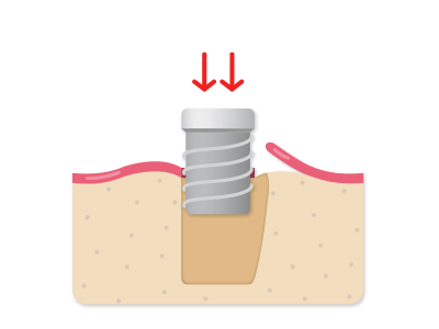 The implant is placed immediately, in the optimal position for the planned restoration.