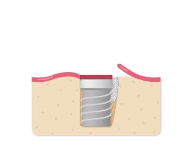 Where bone is lacking, it is reinforced with a graft.