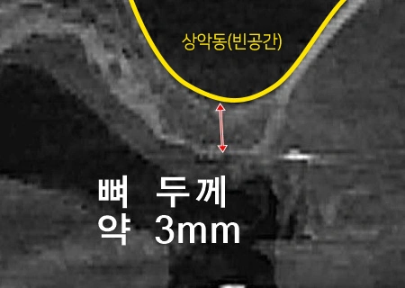 CT로 수술 부위의 뼈 상태를 자세히 확인합니다.