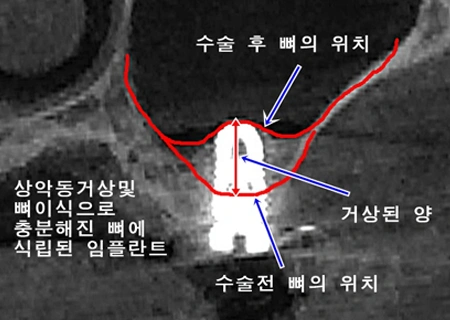 최소절개로 적절한 양의 뼈를 이식하고 임플란트를 식립합니다.
