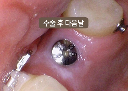 임플란트 크기만큼의 작은 구멍으로 진행해 붓기와 봉합 흔적을 최소화합니다.
