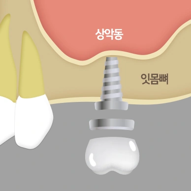 상악동을 거상하고 뼈를 이식해 임플란트를 심는 모습