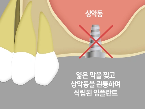 막을 찢고 관통해 식립하면 상악동 천공 문제가 발생할 수 있습니다