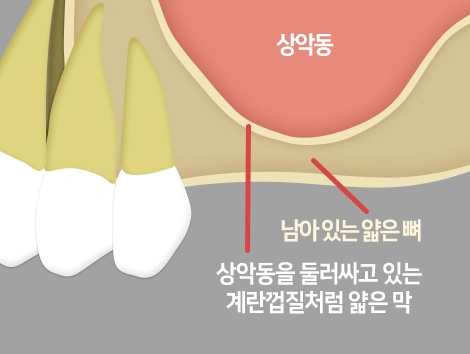상악동을 둘러싼 막은 계란 속껍질처럼 얇습니다