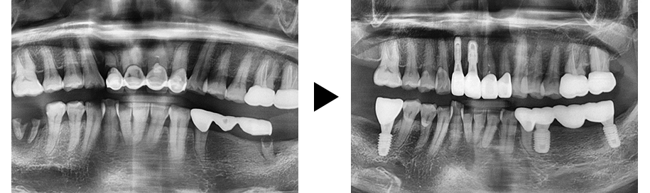 임플란트를 심자마자 임시 지대주를 연결해서 다른 사람들이 보기에는 티가 나지 않도록 바로 임시치아