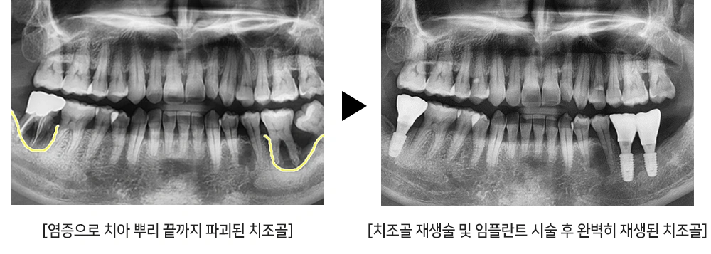심한 치주염과 신경치료 후유증으로 어금니 주변 치아의 치조골이 이미 뿌리 끝 부분까지 모두 파괴