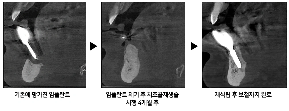 식립된 임플란트 주변의 잇몸뼈가 대부분 녹아 임플란트가 전체적으로 흔들리고 있었고, 주변 잇몸조직 또한 손상이 심한 상태