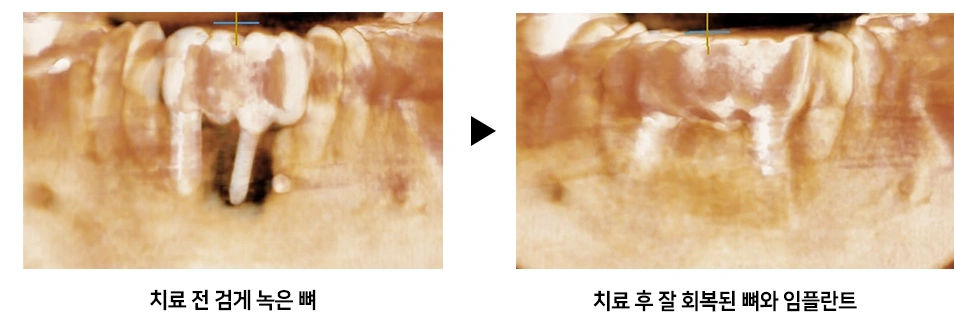 식립된 임플란트 주변의 잇몸뼈가 대부분 녹아 임플란트가 전체적으로 흔들리고 있었고, 주변 잇몸조직 또한 손상이 심한 상태