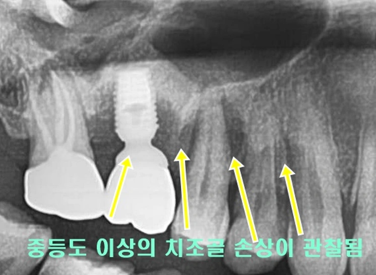 임플란트와 주변의 치아를 제거하고 치조골 재생술과 동시에 새로운 임플란트를 통해 다시 잇몸 건강과 씹는 즐거움을 회복한 경우
