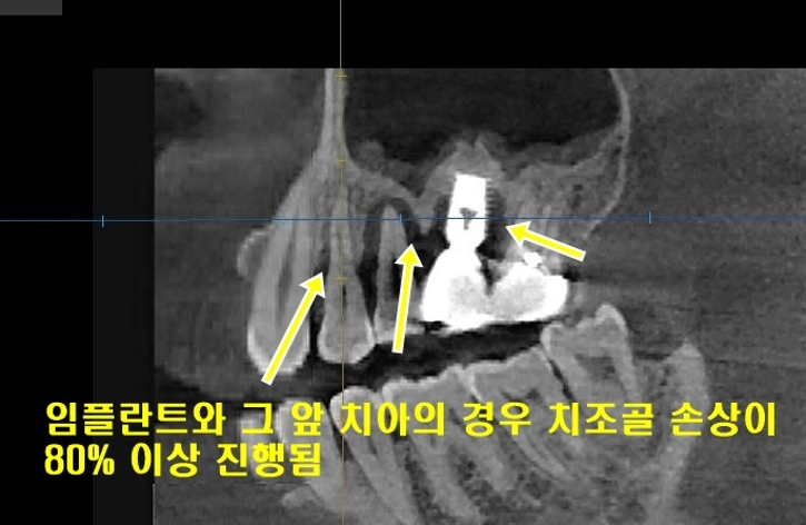 임플란트와 주변의 치아를 제거하고 치조골 재생술과 동시에 새로운 임플란트를 통해 다시 잇몸 건강과 씹는 즐거움을 회복한 경우