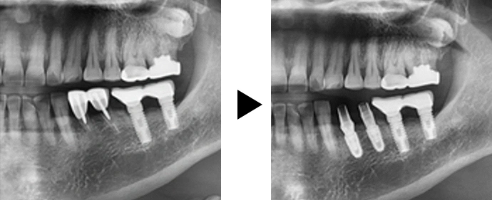수술부터 최종 보철물까지 하루에 완성되어 끝나는 임플란트 수술
