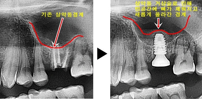 발치 + 상악동 거상술 + 뼈이식 + 임플란트 식립이 모두 함께 필요한 케이스