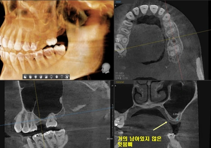계란 속껍질처럼 얇은 상악동에 측방 접근법을 이용해 임플란트 식립