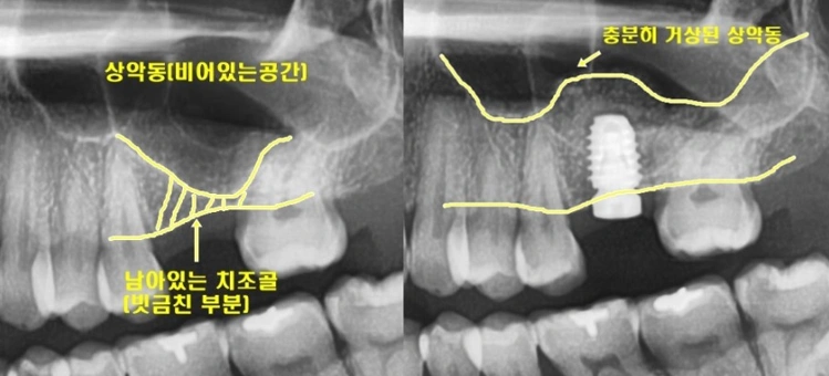 계란 속껍질처럼 얇은 상악동에 측방 접근법을 이용해 임플란트 식립