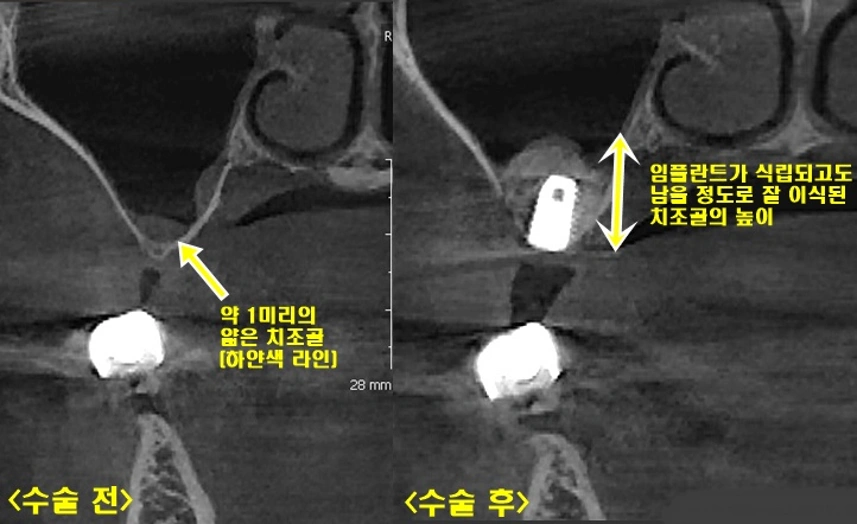 계란 속껍질처럼 얇은 상악동에 측방 접근법을 이용해 임플란트 식립