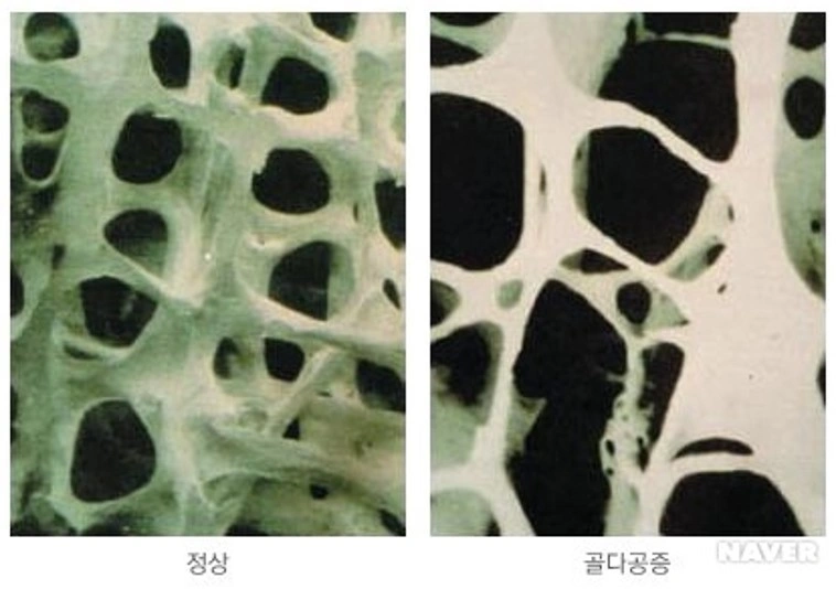 골다공증 치료를 받고 있는 환자 잇몸 뼈이식 후 임플란트 식립을 한번의 시술로 마무리