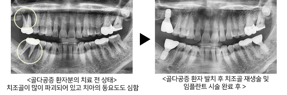 A patient being treated for osteoporosis: bone grafting and implant placement completed in a single procedure